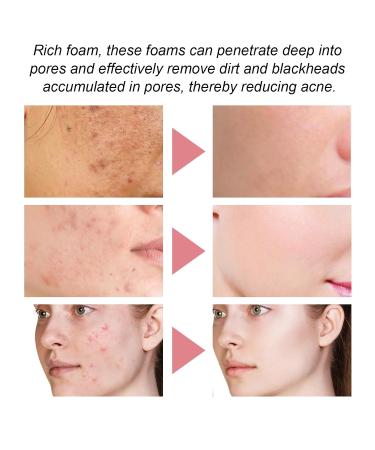 5-in-1 Cleansing Mousse - Deep Moisturizing Oil Control Acne Mark Fading Gentle Face Wash For Hydrated Skin(3PCS) - Buy Online on GoSupps.com