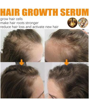 Hair Serum for Hair Growth Ginger Hair Regrowth Serum Ginger Hair Growth Oil for Thinning Repair Hair Follicles Hair Growth Oil for Hair Rapid Growth and Thickening Trengthen Hair Roots 20ML - Buy Online on GoSupps.com