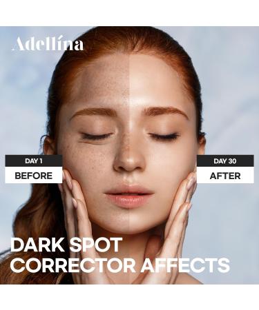 Dark Spot Remover Serum for Face - Niacinamide Age Spot & Freckle Corrector | Advanced Formula for Melasma - 1oz - Buy Online on GoSupps.com