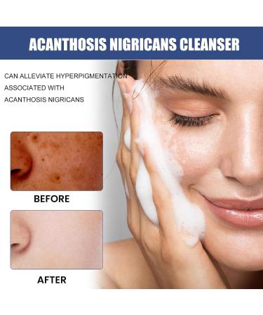 Acne & Spots Cleansing Lotion Relief 50ml | Facial Cleanser for Dry Skin - Reduce Dullness - Buy Online on GoSupps.com
