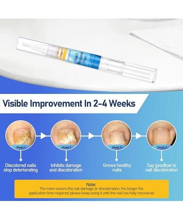 XIFEPFR Toenail Repair Pen - Nail Fingernail Repair Pen for Thick  Broken  Discolored Nails - Restores Healthy Strong Nails - 4PCS - Buy Online on GoSupps.com
