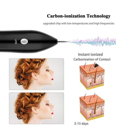 CHRERNA Skin Tags & Mole Removal Kit - 9 Modes Plasma Pen for Warts, Spots, Body & Facial Nevus - Buy Online on GoSupps.com