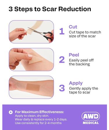 AWD Silicone Scar Tape for Surgical Scars - Pre-Cut Medical Grade Sheets for C Section & Tummy Tuck - 1.6 x 60 Roll - Buy Online on GoSupps.com