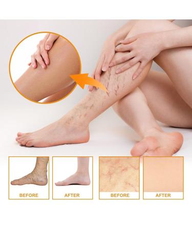 2PCS Varicose Veins Miracle Cream - Vitamin K Formula for Legs & Face | Deeply Nourishing & Moisturizing | All Skin Types - Buy Online on GoSupps.com