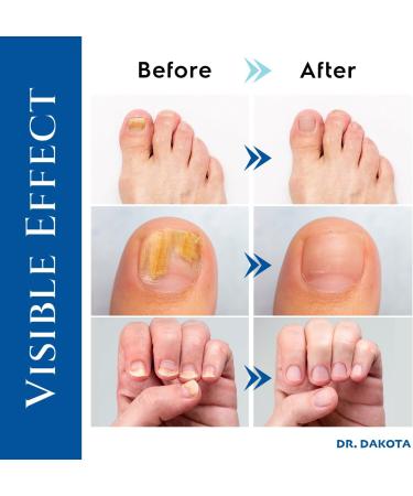 Nail Fungus Treatment For Toenail Fungal Nail Treatment Extra Strength Nail Repair Toe Nail Fungus Treatment Nail Repair Renew Damaged Discolored Foot & Toenails Athletes Foot(30 ml) - Buy Online on GoSupps.com