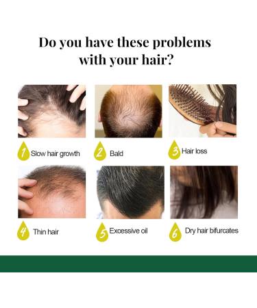 Hair Growth Germinal Oil Anti-Hair Loss Hair Growth Promotes Blood Circulation of the Scalp Prevents Hair Loss - Buy Online on GoSupps.com