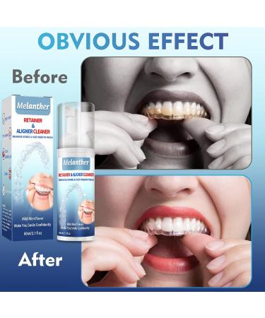 Melanther Retainer Cleaner & Toothbrush - Braces/Aligner Whitening Foam for ClearCorrect, Essix, Vivera & Hawley Trays - Denture Cleaner (120ml) - 2 Pack - Buy Online on GoSupps.com