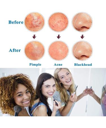 Blackhead Remover Kit Curved Tweezer Blackhead Removal Tools Spot Remover Tools Professional Pimple Comedone Extractor Zit Popper for Nose Face (silver) - Buy Online on GoSupps.com