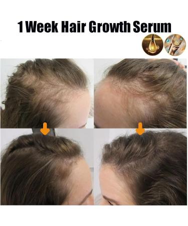 Ginger Huile de croissance des cheveux Ginger anti-chute 7 jours repousse 7 jours huile germ e au gingembre pour nourrir les racines des cheveux r pare les cheveux ab m s nourrit les racines des - Buy Online on GoSupps.com