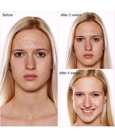 NewWay LED Face Mask Light Therapy for Acne Treatment Skin Care Dark Spot Red Light Therapy for Face Lightweight Cordless & Voice Prompts Comfortable Wear - Buy Online on GoSupps.com