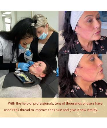 Minovd PDO Gearwheel Thread - 360r Bidirectional Tooth Wheel for V-Face Lift 18g 100mm 20 Pieces - Effective Skin Tightening Solution - Buy Online on GoSupps.com