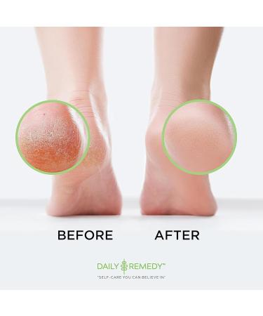 Foot Callus Remover Gel Set - Professional Feet Care for Smooth Skin & Cracked Heels - 8oz Made in USA with Pumice Stone - Buy Online on GoSupps.com