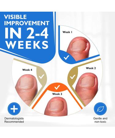 Ingrown Toenail Treatment Kit - 30ml Professional Drops with Shea Butter & Clove Oil for Pain Relief and Easy Trimming - Buy Online on GoSupps.com
