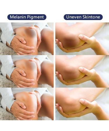 Intimate Areas Skin Lightening Bleaching Cream for Body Sensitive Intimate Area Private Parts Underarm Knees Elbows Inner Thigh Bikini Areas Skin Whitening Cream Dark Spot Remover. 4.73 Fl Oz - Buy Online on GoSupps.com