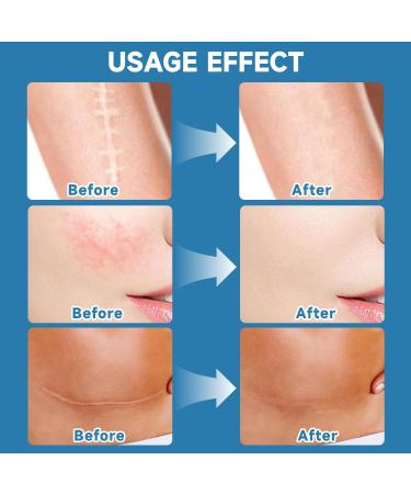 MagiForeign Scar gel scar cream scar removal cream acne scars healing gel for scars surgical scar cream keloid scars acne old and new scars - Buy Online on GoSupps.com