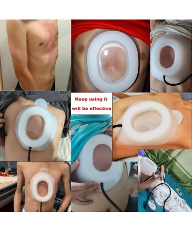 Vacuum Bell Pectus Excavatum Sternal Depression Support Thoracic Depression Brace Physical Correction Sunken Sternum Brace Real-Time Pressure Gauge Monitoring(Small) - Buy Online on GoSupps.com