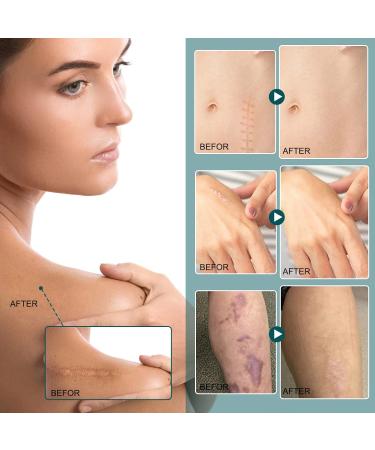 Silicone Scar Sheets Reusable Medical Grade Thinken Scar Sheet for C-Section Tummy Tuck Keloid Surgical Scars Post Surgery Supplies (16pcs-5.9"x1.6"Each Silicone Scar Sheet) - Buy Online on GoSupps.com