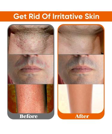 Ingrown Hair Treatment & Razor Bumps Stopper Serum - Alcohol-Free After Shave Solution for Men and Women - Face, Neck, Bikini, Legs, and Underarms - Buy Online on GoSupps.com