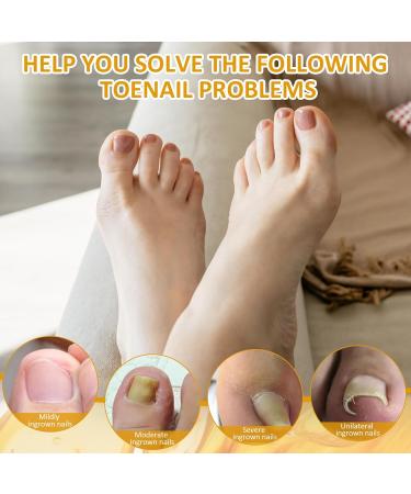 30ml Ingrown Toenail Treatment Drop Natural Ingrown Toenail Correction Oil Cuticle Care Oils for Toe Fungal Nail Treatment Trimming Nail Softening Drop Extra Strong for Damaged Nails - Buy Online on GoSupps.com