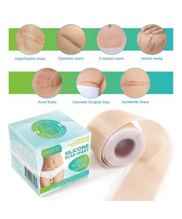 Silicone Scar Sheets & Tape - Medical Scar Removal Strips for Surgery Keloid C-Section Acne | Reusable | 1.6 x 120 Roll - Buy Online on GoSupps.com