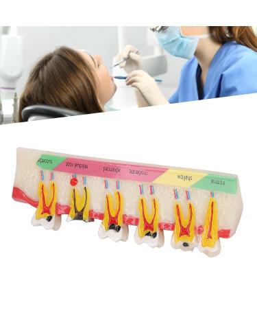 Teeth Model for Dental Education | Portable Dental Caries Development Model for Courses - Buy Online on GoSupps.com