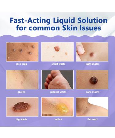 Maximum Strength Wart Remover Liquid with Salicylic Acid - Fast-Acting Wart Treatment for Common Plantar & Genital Warts - 0.68 floz/20ml - Buy Online on GoSupps.com