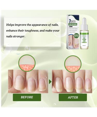 7 Days Nails Repairing Serum Nail Growth Treatment Nail Serum For Strength And Growth Toenail Strengthener For Damaged Nails Restores The Healthy Natural Appearance Of Nails (1) - Buy Online on GoSupps.com
