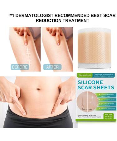 Teksome Scar Tape for Body - 1.5m Stretch Mark Remover Strips | Silicone Gel Tape for Scars & Stretch Marks - Buy Online on GoSupps.com