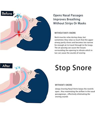 16 PCS Silicone Nose Vents - Anti Snoring Clips & Nasal Dilators - Buy Online on GoSupps.com