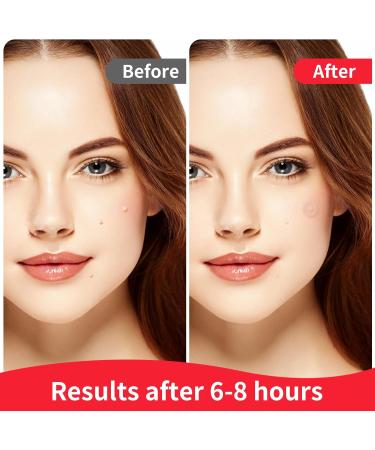 Original Hydrocolloid Acne Pimple Patch - Invisible Spot Stickers for Face & Skin Perfect for Teens - Blemish Coverage & International Shipping - Buy Online on GoSupps.com