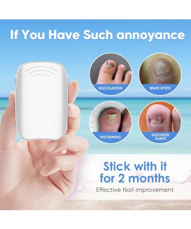 Nail Fungus Laser Treatment Device - Blue Light Therapy for Damaged Toenails & Fingernails - Buy Online on GoSupps.com