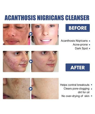 Cleansing Lotion for Acne & Spots | Acanthosis Nigricans Treatment Set - Salyzap Body Wash, Nigrifree Cream, Therapy Oil | 50ml - 1 Count (Pack of 2) - Buy Online on GoSupps.com