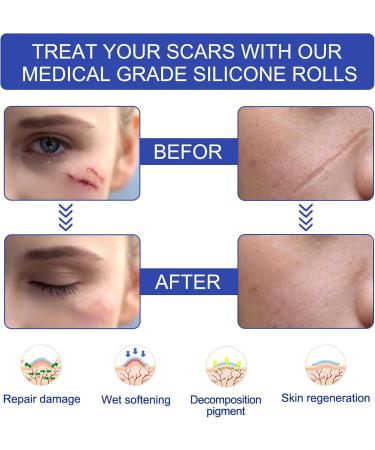 Yissone 1.6x120 Reusable Silicone Scar Sheets - for Softening and Flattening Scars - Silicone Scar Tape Roll - Buy Online on GoSupps.com