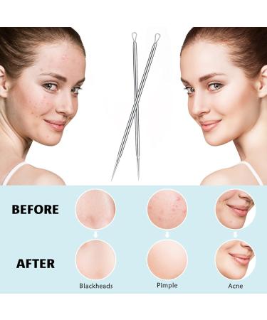 Titanium Blackhead Removal Acne Needle Blasting ToolFacial Acne RemoverTitanium Teardrop Acne Needles 2 Pcs with Iron Case - Buy Online on GoSupps.com