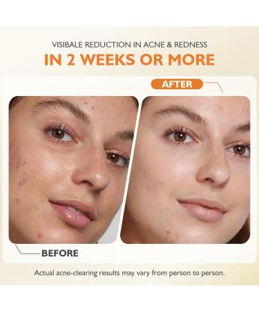 elesysy Organics Acne Killer Day Balm 2.0 Natural Botanical Acne Treatment for Face Body & Back | Reduces Pimples Blackheads & Redness | Balancing Hydrating & Non-Comedogenic Formula - Buy Online on GoSupps.com