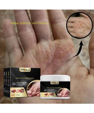 Milageto Natural Ointment 30G - Eliminate Itching, Sweat, Blister & Skin Problems - Buy Online on GoSupps.com