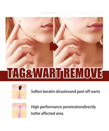 Stylo Anti Verrue Anti Taupe Stylo Pour Enlever Grain De Beaut Anti Cors Pieds Stylo Liquide D' limination Des Verrues Wart Removal Cream Cr me D' limination Instantan e des Verrues 2PC - Buy Online on GoSupps.com