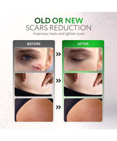 Silicone Scar Sheets Roll (1.6 x 120) - 3M for Post Surgery Treatment | C-Section, Tummy Tuck, Keloid, Acne | Painless Removal - Buy Online on GoSupps.com
