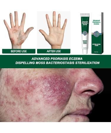 2PCS Herbal Itching Relief Ointment for Eczema Rash Repair - Moisturizing Cream for Dry, Irritated Skin - Buy Online on GoSupps.com