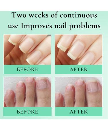 10ml Nail & Cuticle Oil Pen Natural Ingredients Nail Oil Pen Deeply Hydrating Moisturising Cuticle Oil for Nails Moisturizing Nail Oil with Soft Brush Nail Strengthener Clear Nail Polish Strengthening - Buy Online on GoSupps.com