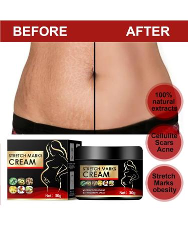 Cr me pour varices limination des varices r parateur de varices cr me pour varices jambes varices enflamm es 20 g 1 pi ce - Buy Online on GoSupps.com