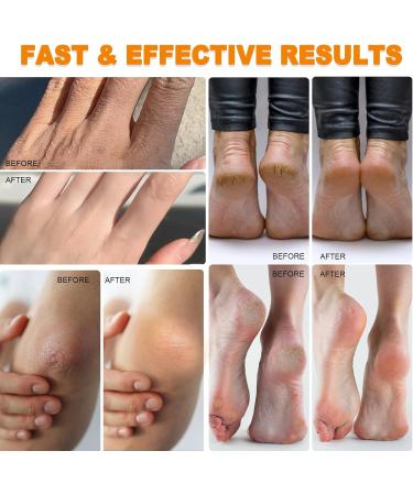  Ruicen Urea 60 Percent Foot Cream with Urea - Buy Online on GoSupps.com