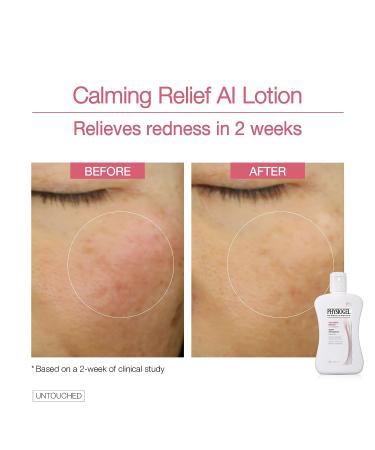 Physiogel Calming Relief A.I. Face Lotion | Soothes Sensitive, Eczema-Prone Skin | Hypoallergenic Formula, 6.7 fl. Oz - Buy Online on GoSupps.com
