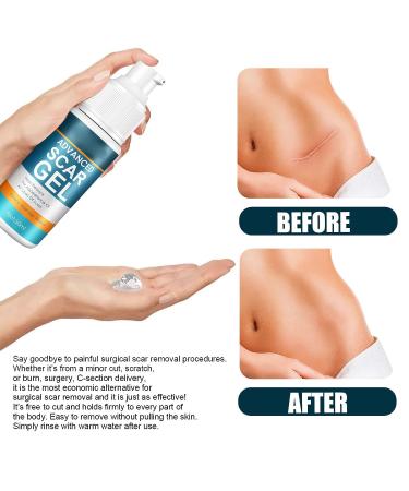 Scar Removal Cream 2pcs - Mild Gel for Old & New Scars, Stretch Marks, Wrinkles - 50ml - Buy Online on GoSupps.com