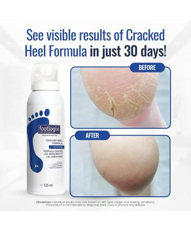 FOOTLOGIX Cracked Heel Formula White 4.23 oz - Best Treatment for Smooth Heels - Buy Online on GoSupps.com