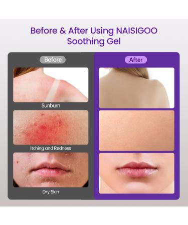 Aloe Vera Gel for After IPL & Laser Hair Removal - Soothes & Hydrates Skin Travel Size 4.1 fl oz with Chamomile Extracts | Sunburn Relief for Women & Men - Buy Online on GoSupps.com