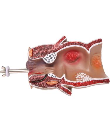 Anatomy Model: Human Rectal Lesion Fistula & Fissure Pathology - Ideal for Teaching | International Shipping - Buy Online on GoSupps.com