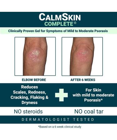 Xenna CalmSkin Complete Gel for Psoriasis Relief | Clinically Proven | Results in 1 Week | Calming Formula | 4 fl. oz - Buy Online on GoSupps.com