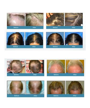 PRO LH272 Laser Helmet for Hair Loss - Effective Hair Growth Treatment for Men & Women - Buy Online on GoSupps.com
