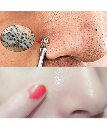 Whitehead Extractor Tool | Comedones Extractor Removal Kit - Stainless Multipurpose Whitehead Extractor Tool With Portable Case For Facial Nose - Buy Online on GoSupps.com